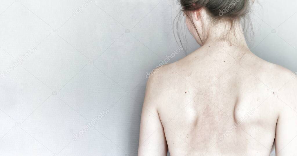 Young woman turned away to white wall, showing unhealthy back with scapular winging. Caucasian naked female with brown hair. Health care of spine, back and shoulder blades. Check up at hospital clinic for doctors visit
