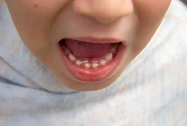 Los Dientes Raíz Del Niño Que Crecen Junto Los Dientes — Foto de Stock