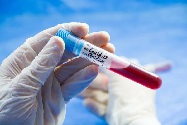 Corona Vírus Positivo Tubos Teste Sangue Fundo Branco Tiro Estúdio — Fotografia de Stock