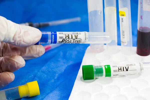 HIV and aids infection test, tube with blood on the blue background. Studio shoot.