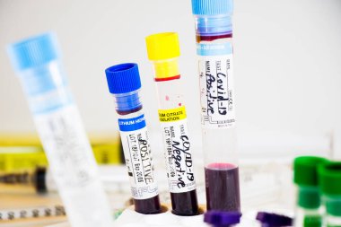 Beyaz arka planda Corona virüsü ve Covid-19 pozitif kan test tüpleri, stüdyo çekimi. Kan testi örnekleri. Teşhis ve laboratuvar.