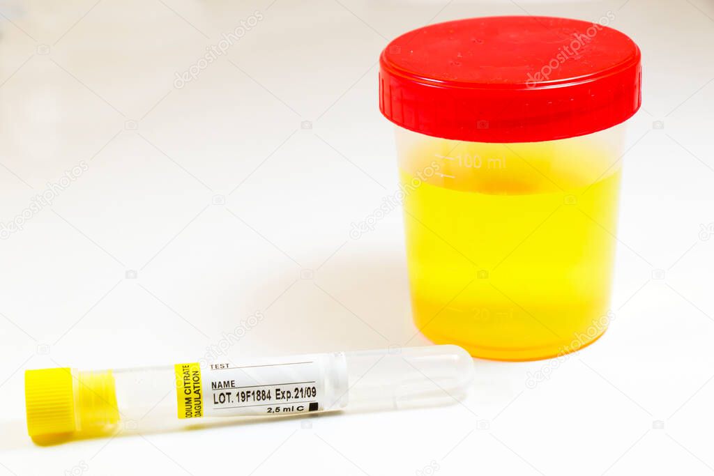Drug test, medical urine and pee test with blood and other tubes on the white background, colorful lab test containers, viruses and doping laboratory tests. Covid 19, HIV, aids and other infections