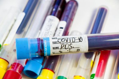 Beyaz arka planda Corona virüsü ve Covid-19 pozitif kan test tüpleri, stüdyo çekimi. Kan testi örnekleri. Teşhis ve laboratuvar.