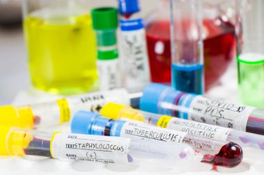 H1N1, Covid-19, Hepatit C, Tüberküloz ve Staphylococcus virüsleri tüplerdeki kan testleri, laboratuvar teşhisleri, metinler ve mektuplar.