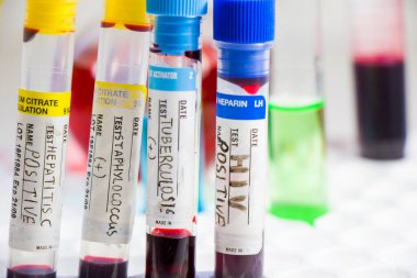 H1N1, Covid-19, Hepatit C, Tüberküloz ve Staphylococcus virüsleri tüplerdeki kan testleri, laboratuvar teşhisleri, metinler ve mektuplar.