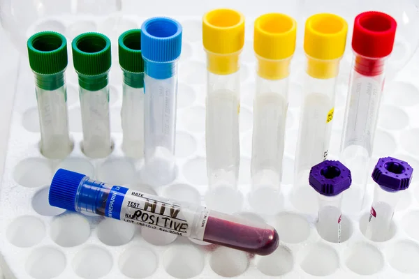 Зразок Аналізу Крові Діагностика Лабораторні Хімічні Рідкі Елементи Студійна Стрілянина — стокове фото