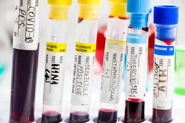 H1N1 Covid Hepatitis Tuberkulose Und Staphylokokken Viren Bluttests Röhrchen Labordiagnostik — Stockfoto