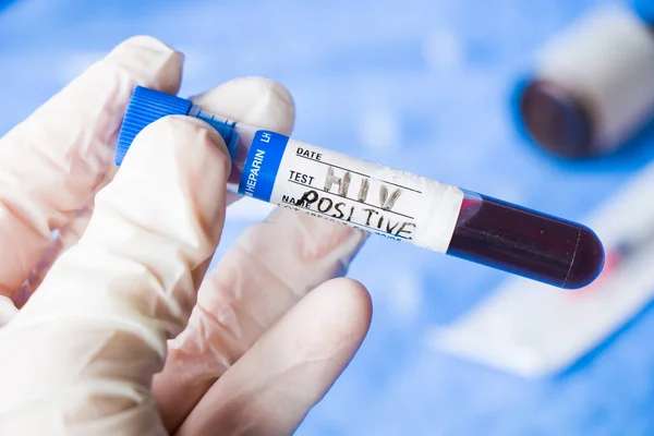 Hiv and aids infection test, hand holding tube with blood on the blue background. Studio shoot.