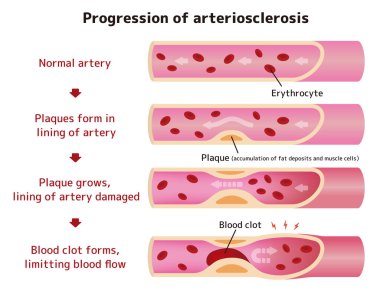 Arterioskleroz illüstrasyonunun ilerlemesi