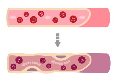 Sağlıklı kanın çeşitli sağlıksız faktörler yüzünden çamurlu kan haline geldiği ve arterioskleroz neden olduğu yanılsaması.
