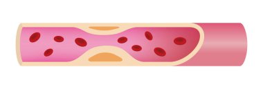 Arteriosklerozlu atardamar ileri düzeyde illüstrasyon