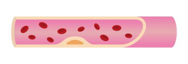 Arteriosklerozlu atardamar ileri düzeyde illüstrasyon