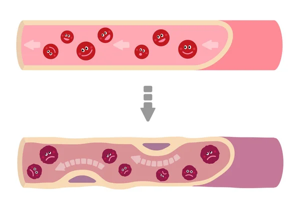 Illustration Som Friska Blod Blir Lerigt Blod Grund Olika Ohälsosamma — Stock vektor