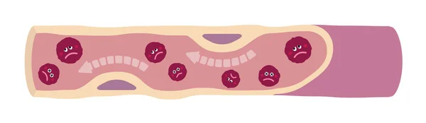 Γελοιογραφία Απεικόνιση Των Λασπωμένων Αιμοφόρων Αγγείων — Διανυσματικό Αρχείο