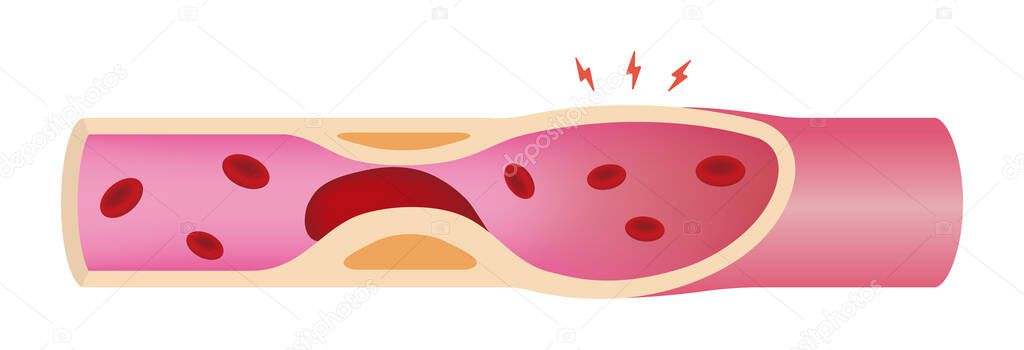 Artery with arteriosclerosis advanced illustration