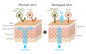 Sekční pohled na pokožku.Srovnání ilustrace ochranného účinku mezi zdravou kůží a poraněnou kůží
