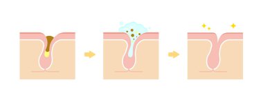 Gözeneklerin yapısal çizimi / Temizleme keratotik tıpası (beyaz başlıklar, siyah başlıklar) temizleme ile.