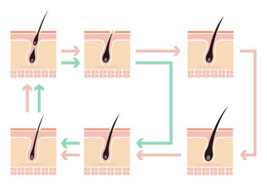Normal saç döngüsü ve AGA 'nın karşılaştırmalı çizimi (androgenetik alopecia)