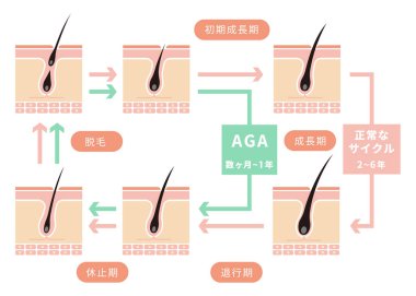 Normal saç döngüsü ve AGA 'nın karşılaştırmalı çizimi (androgenetik alopecia)