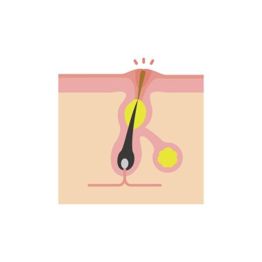 Gözeneklerin kesiti (akne ilerlemesi) / Beyazkafa