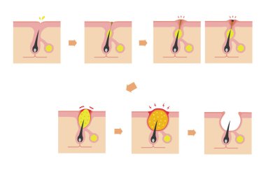 Sivilce tipleri ve ilerleme çizelgesi
