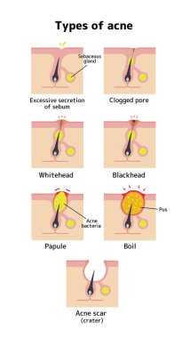 Acne types and progression illustration clipart