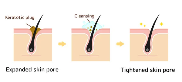 Struktura Ilustracja Porów Clear Keratotic Plug Białe Głowy Zaskórniki Oczyszczania — Wektor stockowy