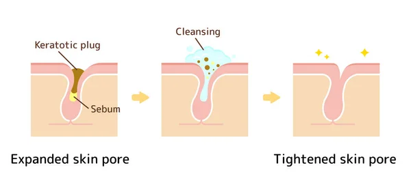 毛穴の構造図 汚れのある角栓 — ストックベクタ