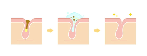 带清洗的毛孔 透明角膜插头 结构图解 — 图库矢量图片