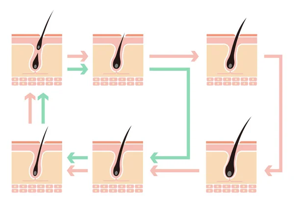 Vergleichende Darstellung Des Normalen Haarzyklus Und Der Aga Androgenetische Alopezie — Stockvektor