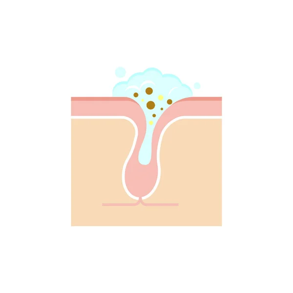 Ilustração Estrutura Dos Poros Limpeza Plug Queratótico Claro Whitehead — Vetor de Stock