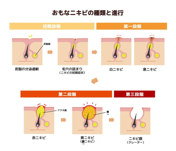 Akne Typen Und Progression Illustration Japanisch — Stockvektor