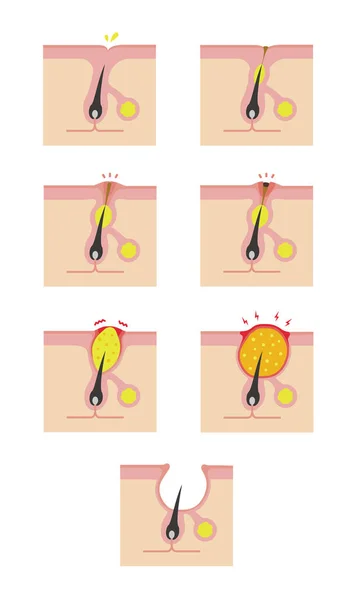 Tipos Acné Ilustración Progresión — Vector de stock