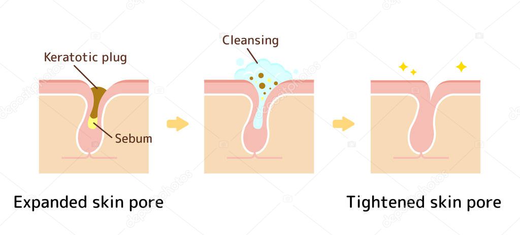 Structure illustration of pores / Clear keratotic plug (whiteheads ,blackheads ) with cleansing.