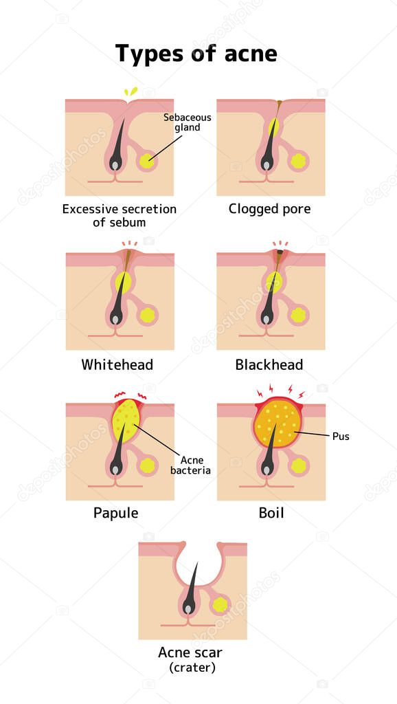 Acne types and progression illustration