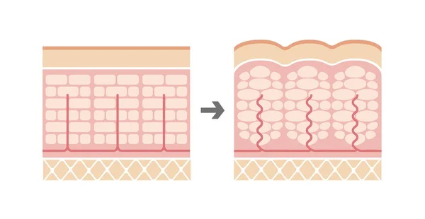 普通の皮膚とセルライトの皮膚の比較図 — ストックベクタ