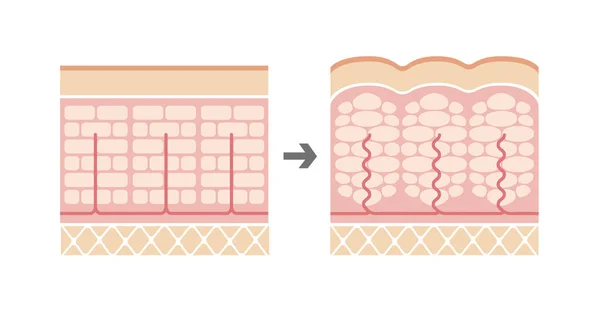 Ilustración Comparativa Piel Normal Piel Celulitis — Vector de stock