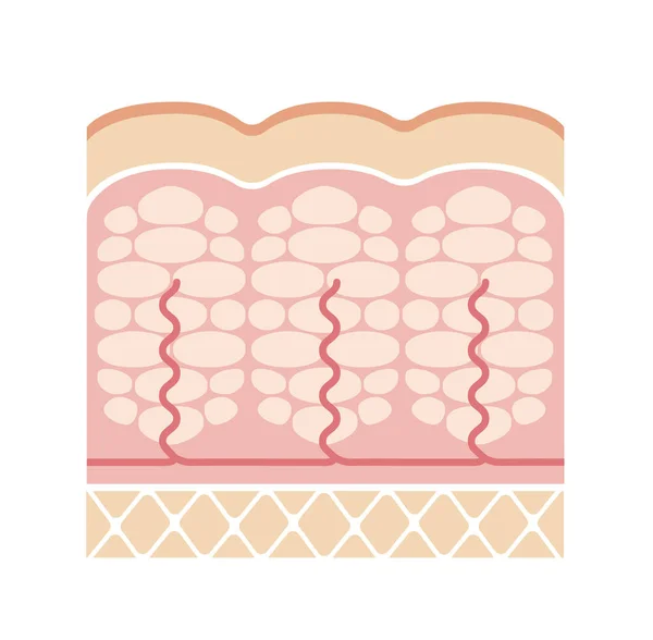 Εικόνα Της Διατομής Του Δέρματος Της Κυτταρίτιδας — Διανυσματικό Αρχείο