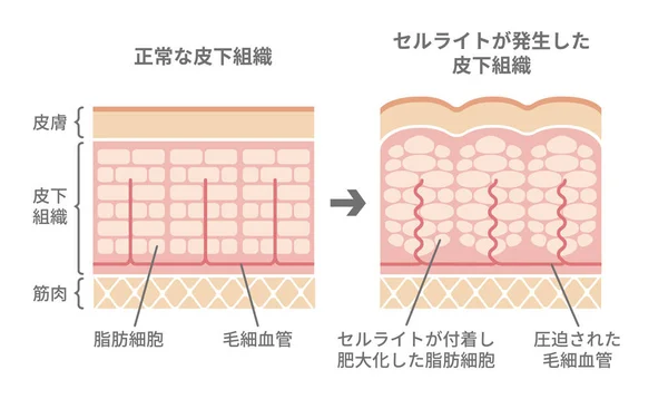 Comparative Illustration Normal Skin Cellulite Skin Japanese — Stock Vector