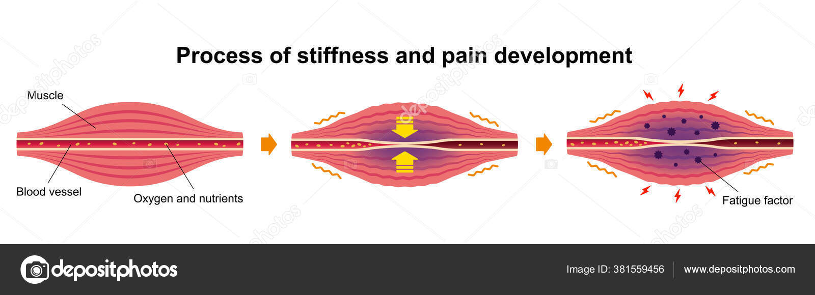 Cause Muscle Stiffness Pain Illustration Steps Stock Vector Barks cause-muscle-stiffness-pain-illustration-steps-stock-vector-barks