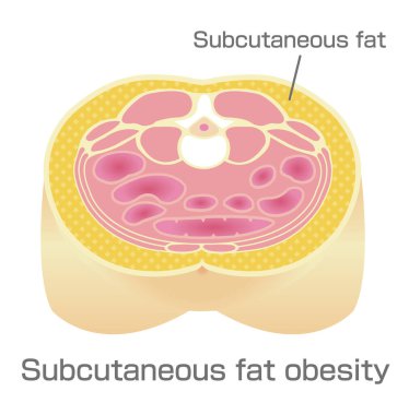 Obezite illüstrasyonu. Abdominal Kısmi Görünüm (deri altı yağ).