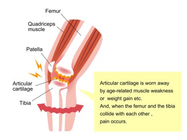 Dizdeki eklem ağrısı (gonartrosis / osteoartrit / artrosis) mekanizması ve nedenleri. düz resimleme.