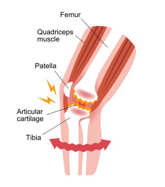 Dizdeki eklem ağrısı (gonartrosis / osteoartrit / artrosis) mekanizması ve nedenleri. düz resimleme.
