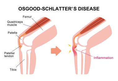 Osgood-schlatter hastalığı (diz eklem hastalığı) illüstrasyonu