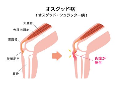 Osgood-schlatter hastalığı (diz eklem hastalığı) çizimi (Japonca)
