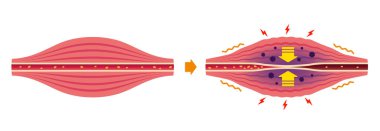 Kas sertliğinin ve acı illüstrasyonunun nedeni