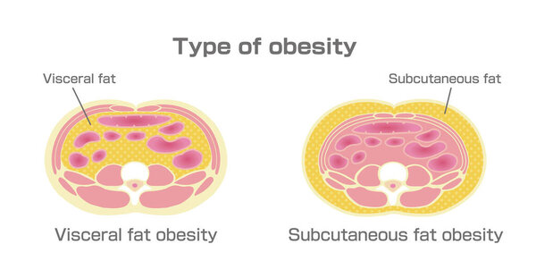 Вид иллюстрации ожирения. Вид на брюшную полость. (висцеральный жир, подкожный жир
)