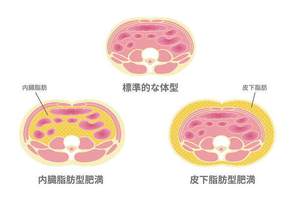 Вид иллюстрации ожирения. Вид на брюшную полость. (висцеральный жир, подкожный жир
)