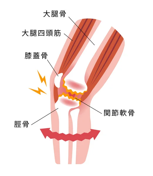 통증의 메커니즘 Gonarthrosis Osteoarthritis Arthrosis Knee 평면의 — 스톡 벡터