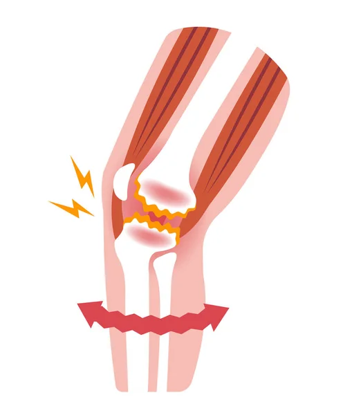 Meccanismo Cause Del Dolore Articolare Del Ginocchio Gonartrosi Osteoartrite Artrosi — Vettoriale Stock